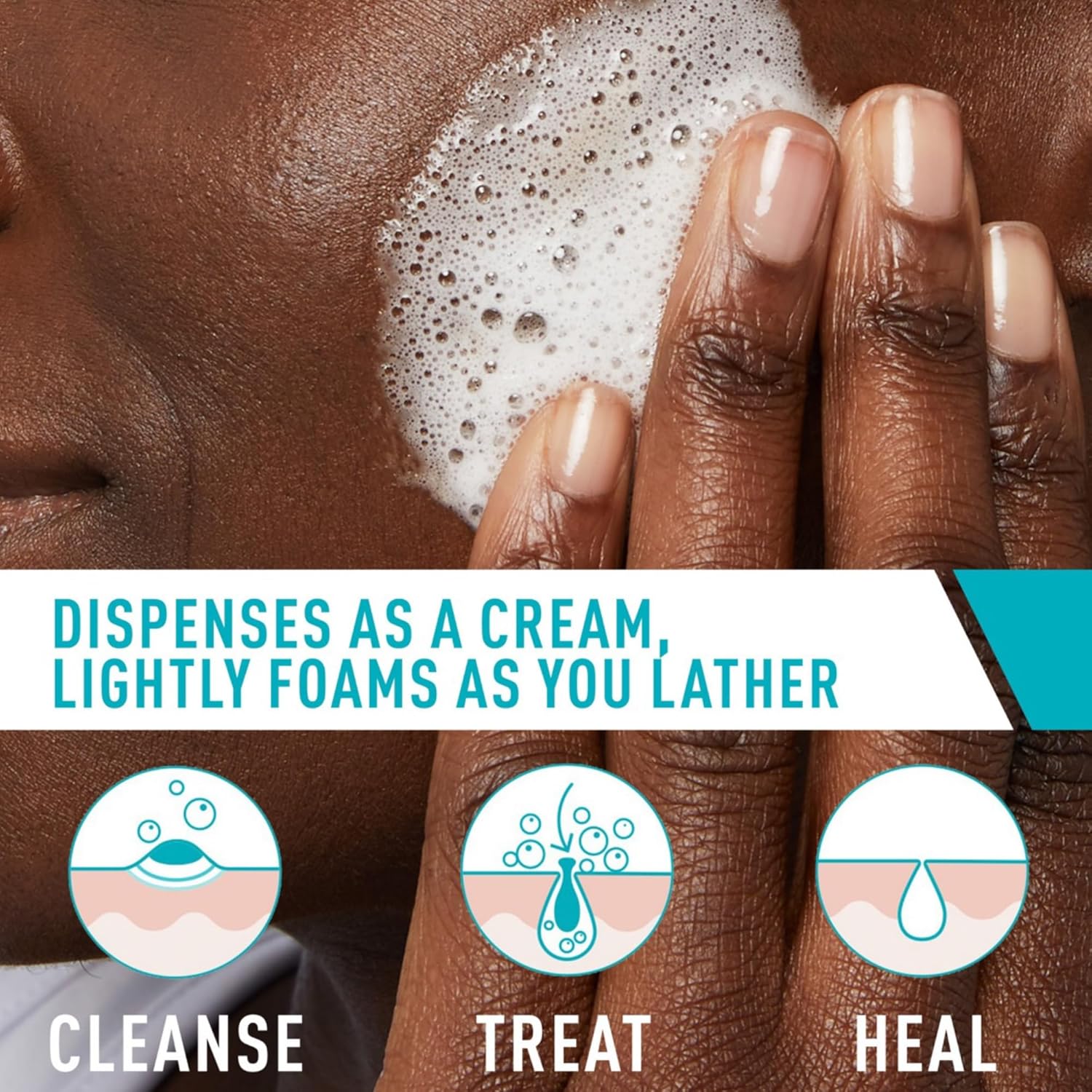 CeraVe Acne Foaming Cream Cleanser - 4% Benzoyl Peroxide Face Wash with Hyaluronic Acid, Niacinamide & Ceramides